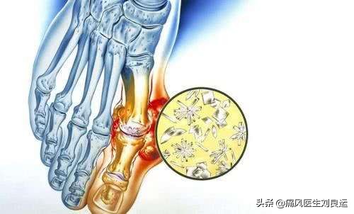 降尿酸的药非布司他能不能吃,降尿酸药非布司他林需要服用多久