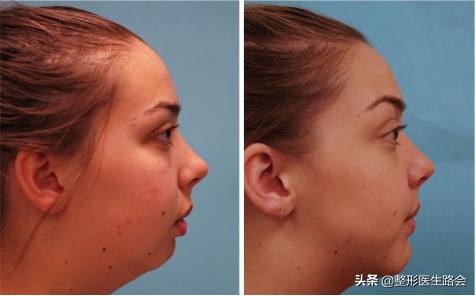 鐗欓娇澶栧嚫涓嬪反鍚庣缉鎬庝箞鐭,涓颁笅宸村彲浠ユ敼鍠勭墮榻垮悗缂╁悧