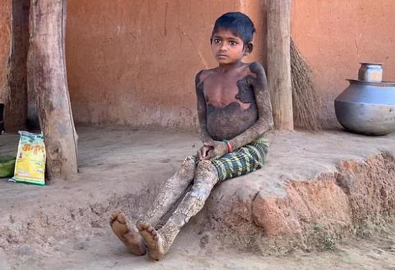 女孩离奇变石头人,印度专家一脸懵,中医鱼鳞病专家却这样说