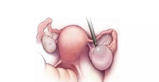 这个方子和穴位，专调肌瘤与囊肿，可惜知道的人太少了