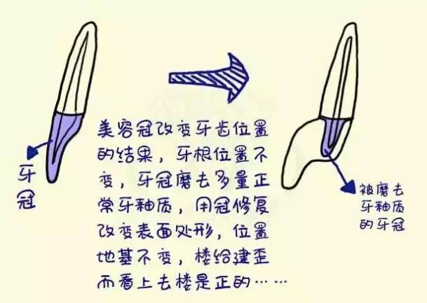 前牙磕掉一个小尖怎么修复,换过的牙磕掉了一小块怎么修复