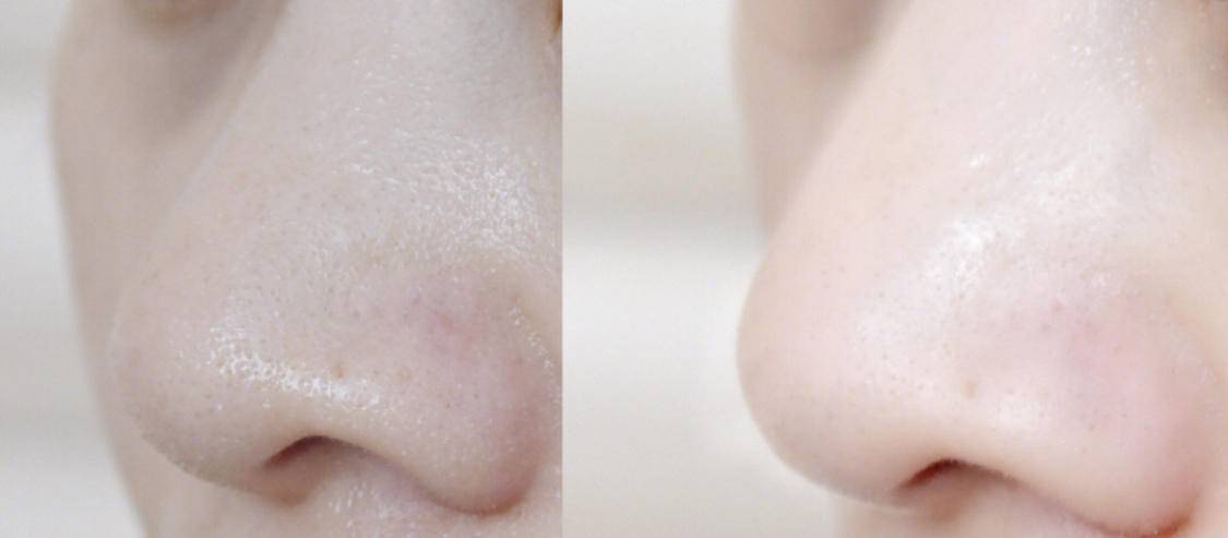 刷酸到底好不好,美容刷酸的副作用是什么