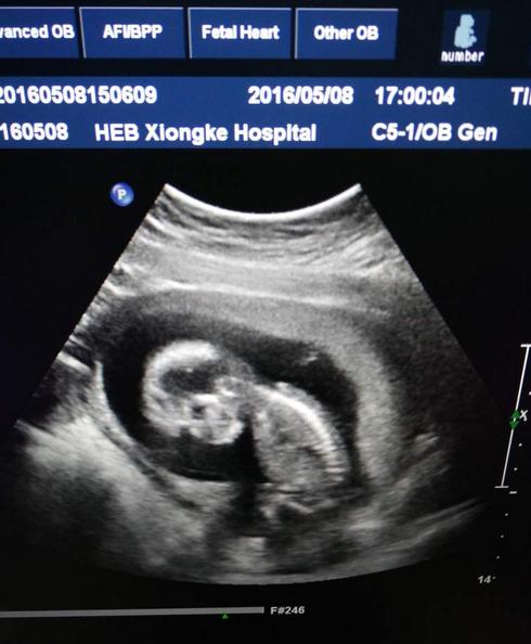 胎儿自然分娩有什么预兆,临产翻胎的正确方法