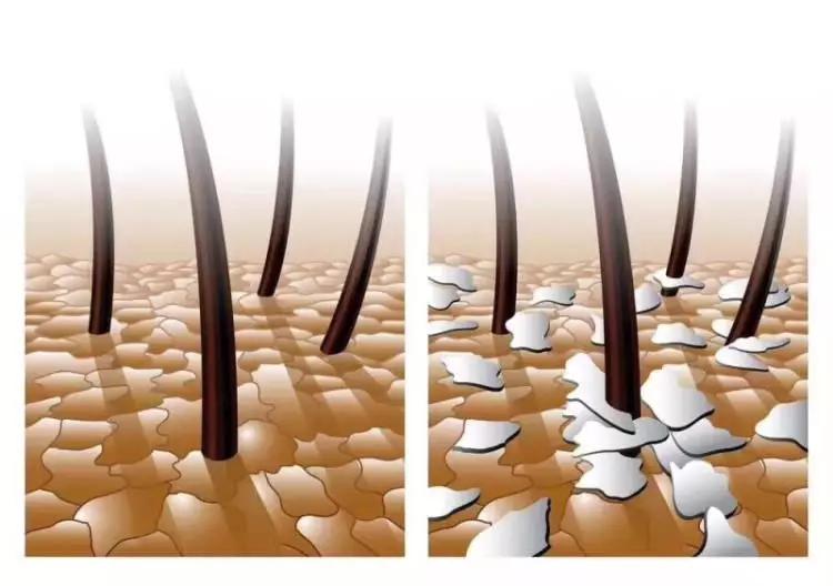 头皮屑过多怎么去除头皮屑,头皮屑特别多如何去掉头皮屑