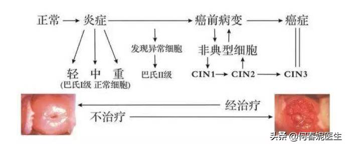 宫颈癌癌前病变复发的几率有多高,宫颈癌癌前病变一般怎么治疗