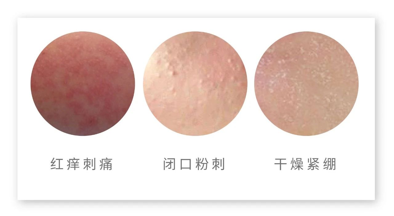 换季皮肤干燥起皮怎么办,手掌每年春夏和夏秋换季脱皮