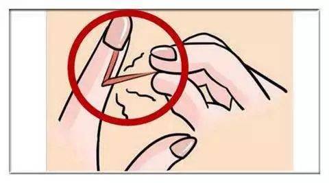 怎么治疗甲沟炎不让往肉里长,快速治疗甲沟炎的小妙招