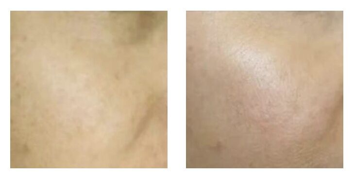 追求素颜肌必做项目之光子嫩肤——皮肤的“十全大补丸”