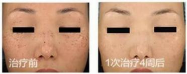 神乎其技的针灸手法,皮秒仪器什么样子