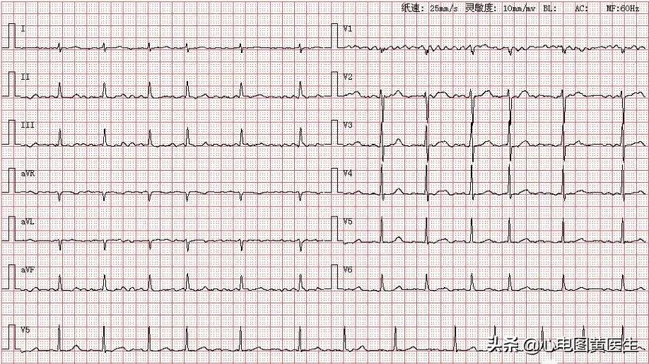 多形性室性心动过速心电图图片,心电图临床意义及正常值