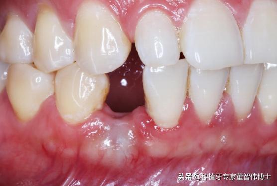 全冠修复与种植区别,全口即刻种植修复详细流程介绍