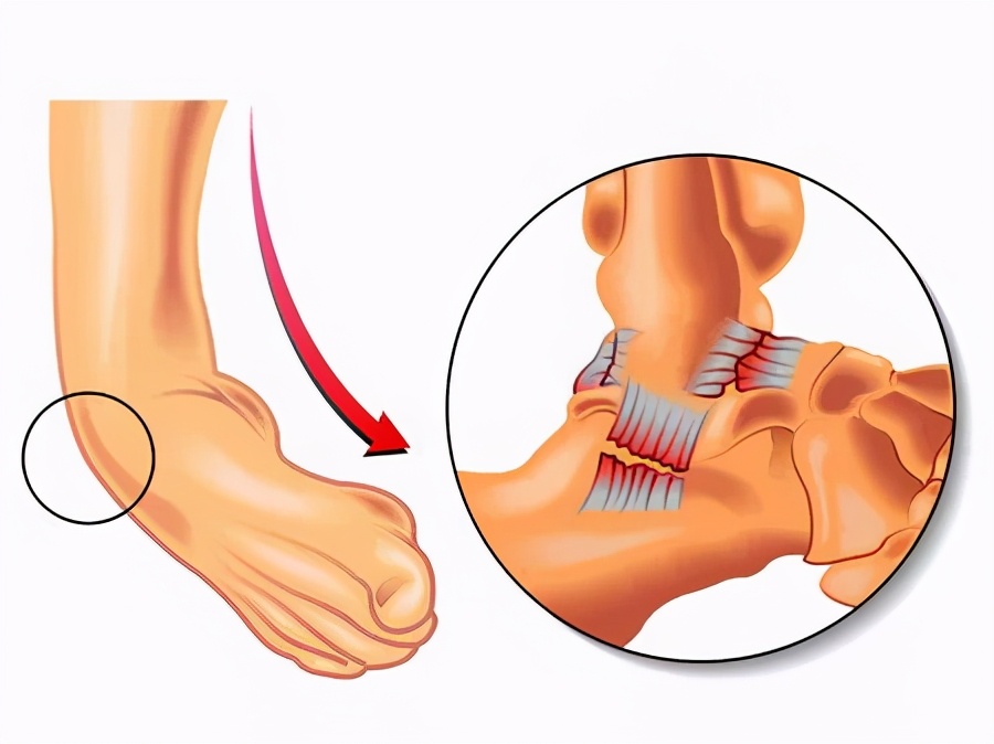 崴脚后的处理过程和注意事项,摔跤崴脚怎么处理恢复最快