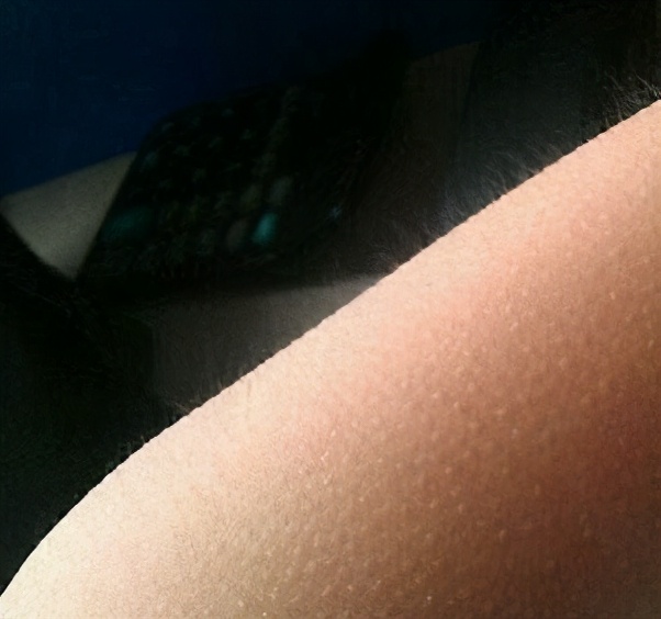 哪种毛适合激光脱毛,最近的激光脱毛