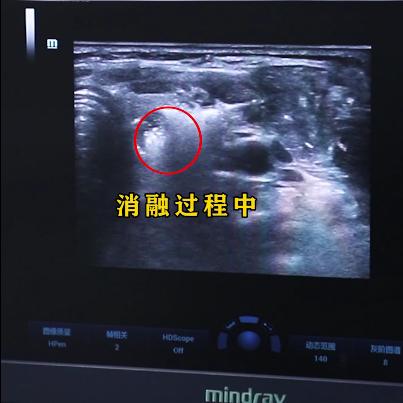 手术根治能彻底治愈吗,手术做不好怎么处理