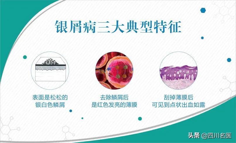 钱没少花却过得一塌糊涂,得了银屑病怎么开导