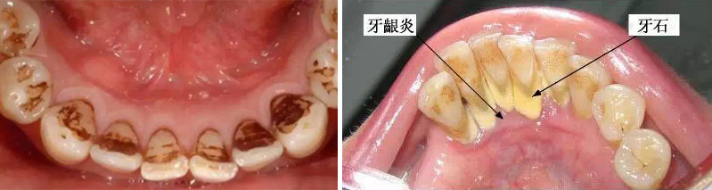 抽烟人的牙膏推荐,澳洲本命牙膏测评