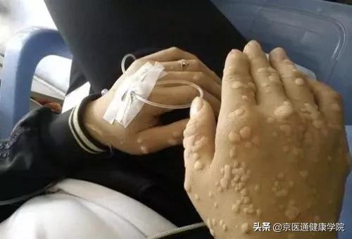 粟丘疹与汗管瘤脂肪粒去除小妙招,粟粒疹扁平疣