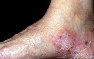 艾滋病窗口期皮肤瘙痒挠了会怎样,浑身皮肤瘙痒越挠越痒怎么解决