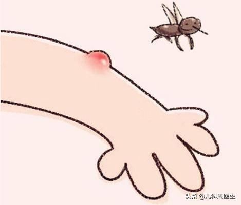 夏日蚊虫咬,蚊虫叮咬季节怎么驱蚊