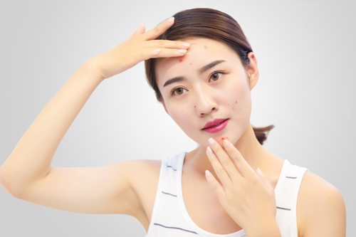 起痘痘后的黑印怎么去,有痘痘有痘印怎么祛