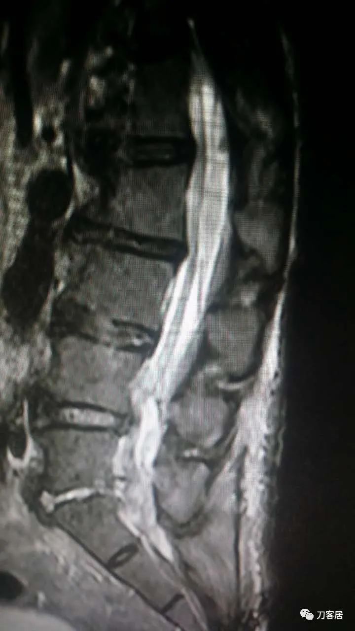 腰椎手术切掉棘突,腰突微创后出血肿
