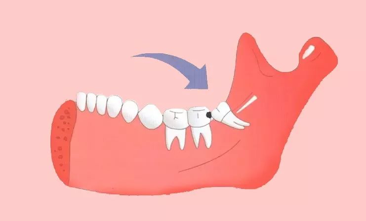 如何避免吃饭时咬到腮帮子或舌头,咬到舌头是不是准备吃肉呢