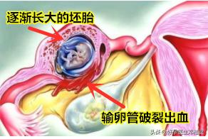 3次宫外孕保守治疗,宫外孕3次怎么办