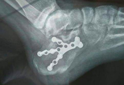 摔跤后骨折保守治疗,摔跤后脚跟痛怎么解决