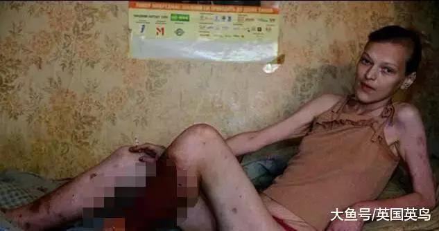 *洛因海**的廉价替代品，“鳄鱼”泛滥，吸食者皮肤溃烂如鳄鱼鳞片