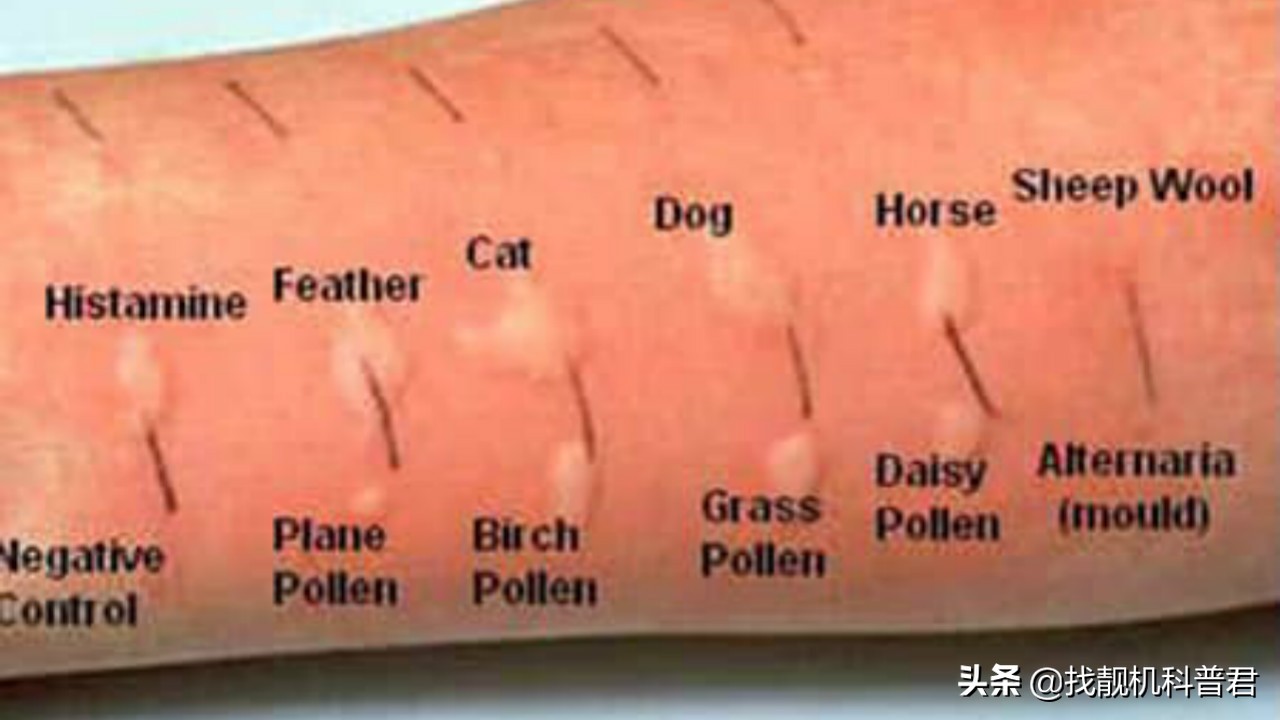 过敏反应短视频,类过敏反应与过敏反应的区别