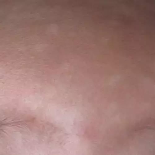 花斑糠疹怎么治疗,孩子得了花斑糠疹用什么药