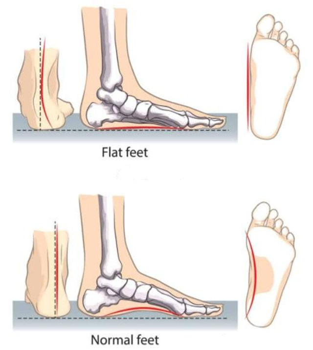 穿哪种鞋子更容易得扁平足,扁平足穿鞋难看怎么办