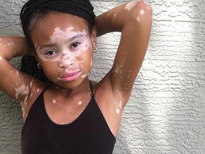 白斑随“期”而变，不同时期白癜风的特点你知道多少？