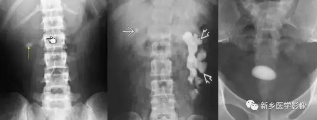 左肾可见高密度影不是结石,结节状高密度影是结石吗