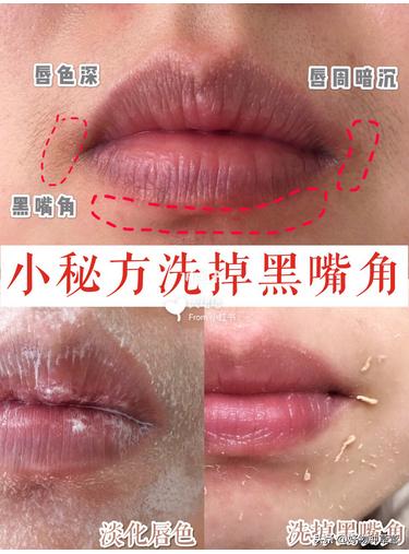 不花一分钱怎样快速祛痘,不花一分钱轻松祛斑