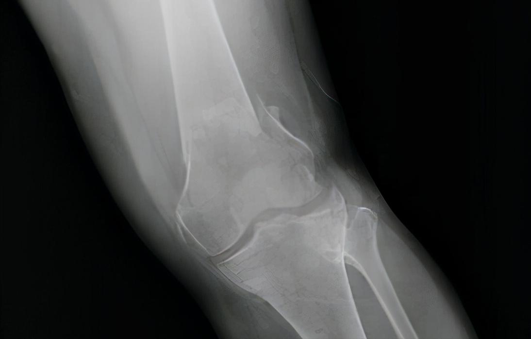 走平路上下楼膝盖疼怎么回事,膝盖下楼梯痛走平路也痛什么原因