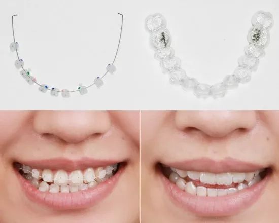 牙齿矫正全过程都在这里了,牙齿矫正一定要知道的事儿