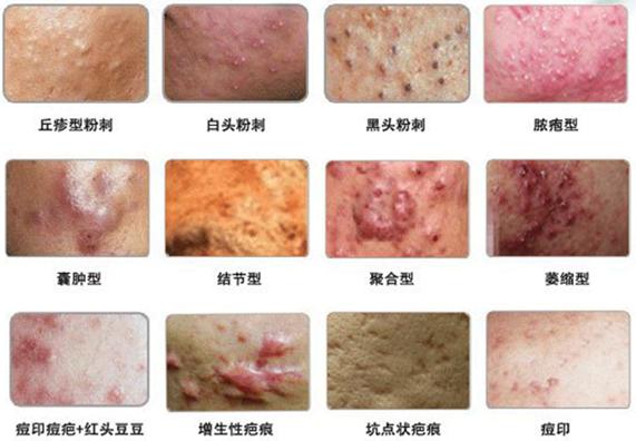 关于各种痘痘的在线咨询,治疗痘痘的分享