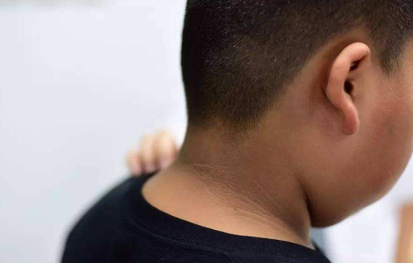 脖子上有类似黑泥,脖子上都是黑色老泥要怎么去除