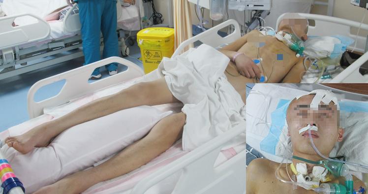 开颅手术后颅内细菌感染图片,外伤开颅手术后脑积液能恢复吗