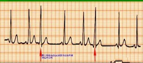 心脏早搏是什么原因严重吗,心脏早搏是一种严重的病吗