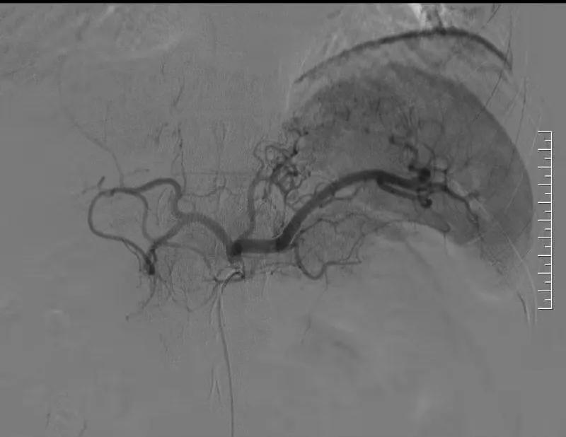生命不能承受之重完整版视频,胃左动脉栓塞减肥手术后遗症
