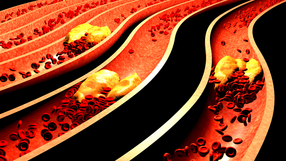 血栓如果不治的情况下能挺多久,血栓最怕这3个动作坚持一个月
