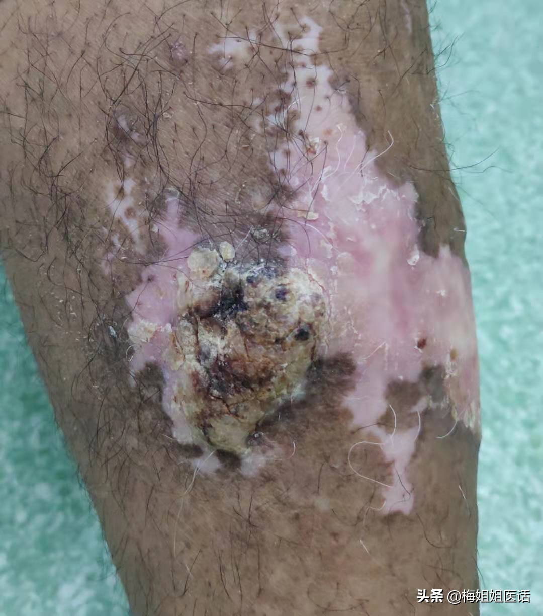 手皮疹越来越痒,拒绝瘙痒