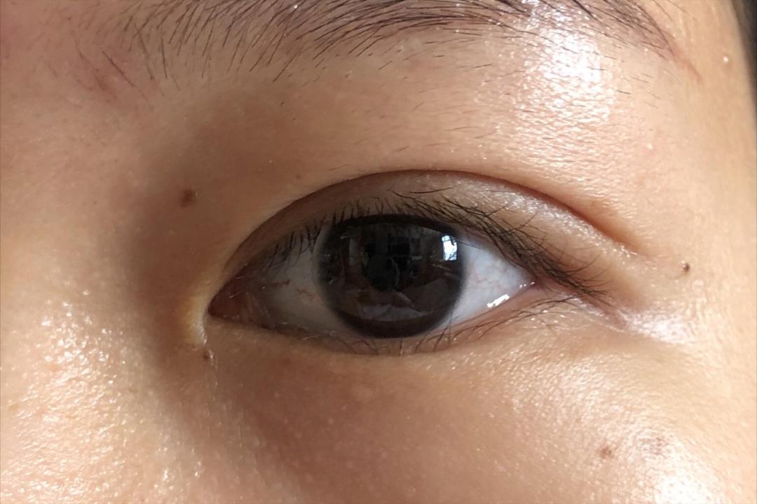 做个双眼皮手术30000块钱贵吗,做双眼皮花了15000贵了吗