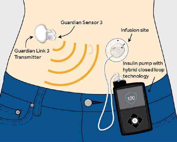糖尿病患者佩戴胰岛素泵,1型糖尿病人戴胰岛素泵的好处