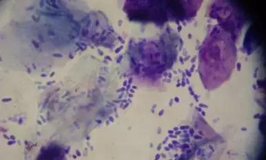 头皮屑多怎么办9个方法告别头屑,头皮屑多怎么办快速消除用什么药