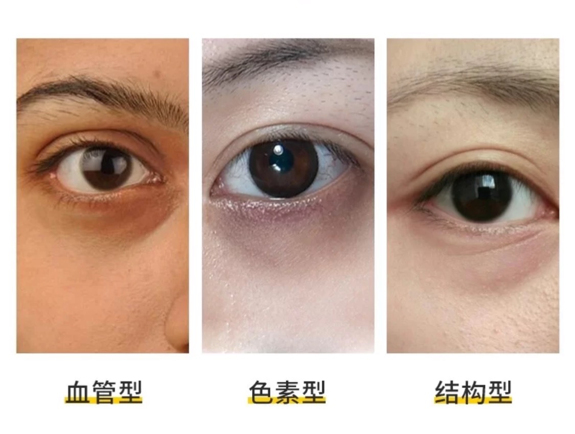 5分钟带你了解眼部问题，面对眼纹不惊慌，快来抄作业