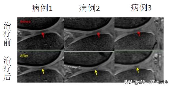 再生修复PRP是神物吗，是否存在夸大营销？骨科医生告诉你