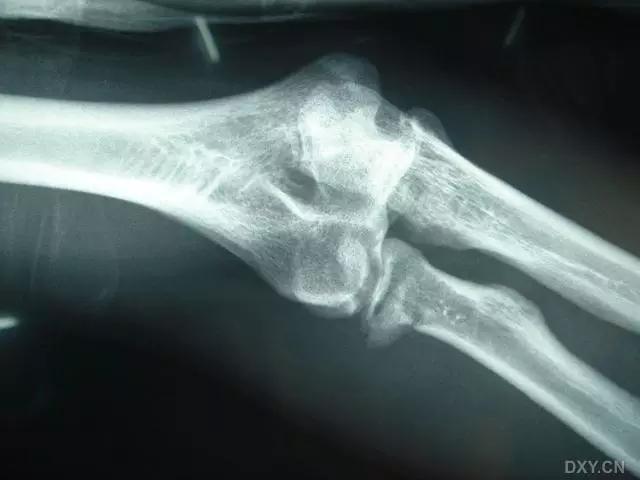 特殊骨折类型,特殊骨折体征